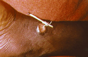 マッチ棒にギニア虫を巻きつけヒトの足から取り除く（By CDC [Public domain], via Wikimedia Commons）