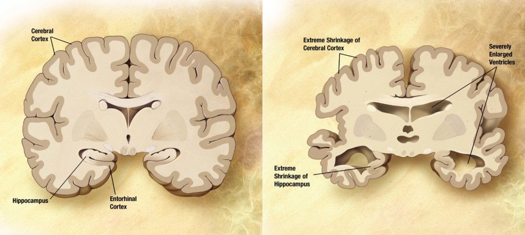 通常の老人の脳（左）とアルツハイマー型認知症患者の脳（右）。アルツハイマー型認知症では大脳皮質、海馬の萎縮、および脳室の拡大が見られるようになる（By derivative work: Garrondo [Public domain], via Wikimedia Commons）