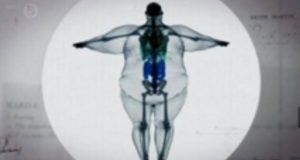 ９８０ポンド（４４４キロ）の男性の脂肪と骨格