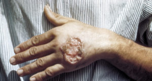 「森林梅毒」とよばれた「リーシュマニア症」の例。これが顔面にも広がる（CDC/ Dr. D.S. Martin / Public domain）