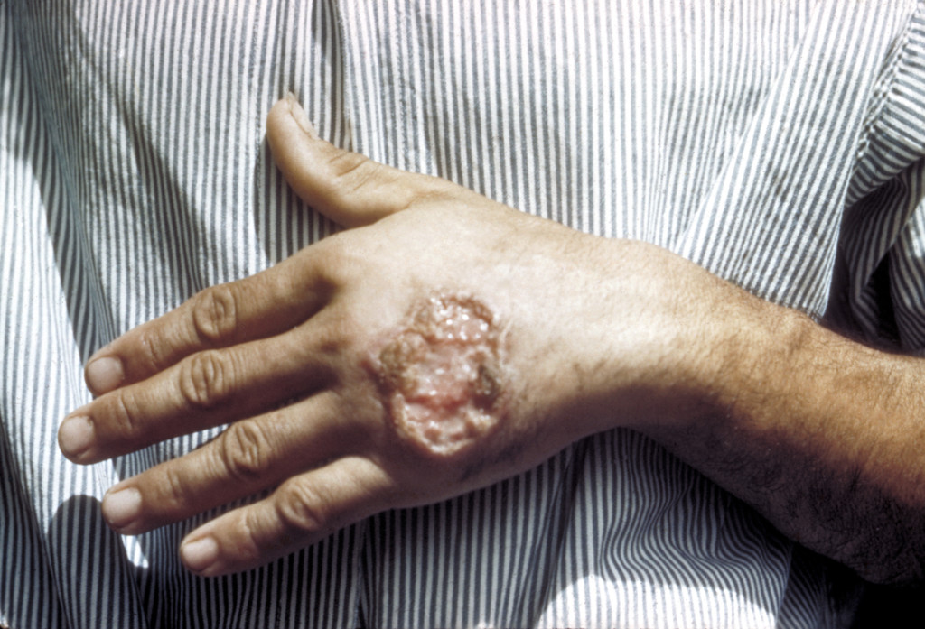 「森林梅毒」とよばれた「リーシュマニア症」の例。これが顔面にも広がる（CDC/ Dr. D.S. Martin / Public domain）